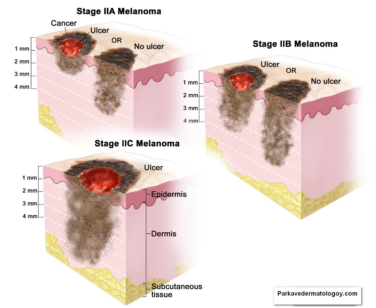 Melanoma Treatment