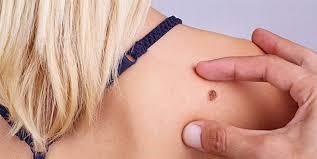 melanoma treatment and mole